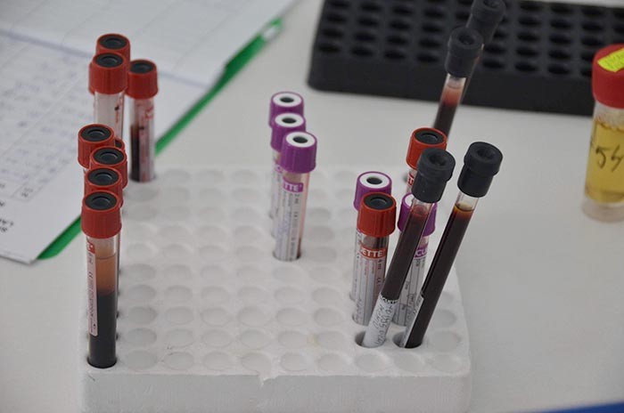 Depresia ar putea fi depistată doar printr-un test de sânge Depresia ar putea fi depistată doar printr-un test de sânge