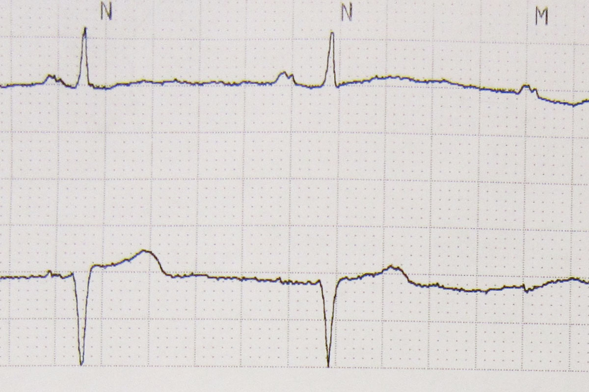 40% dintre români suferă de hipertensiune arterială