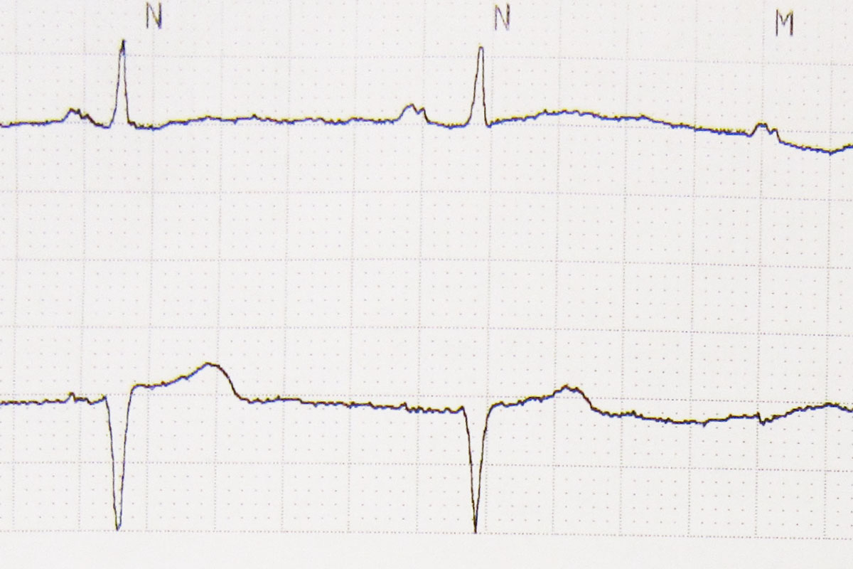 Antrenamentele intense, un ajutor pentru cardiaci