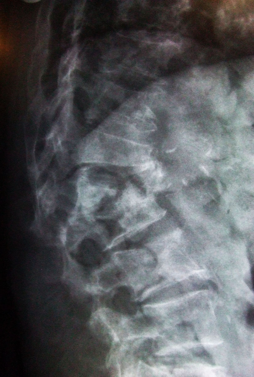 Ziua Mondială a Osteoporozei