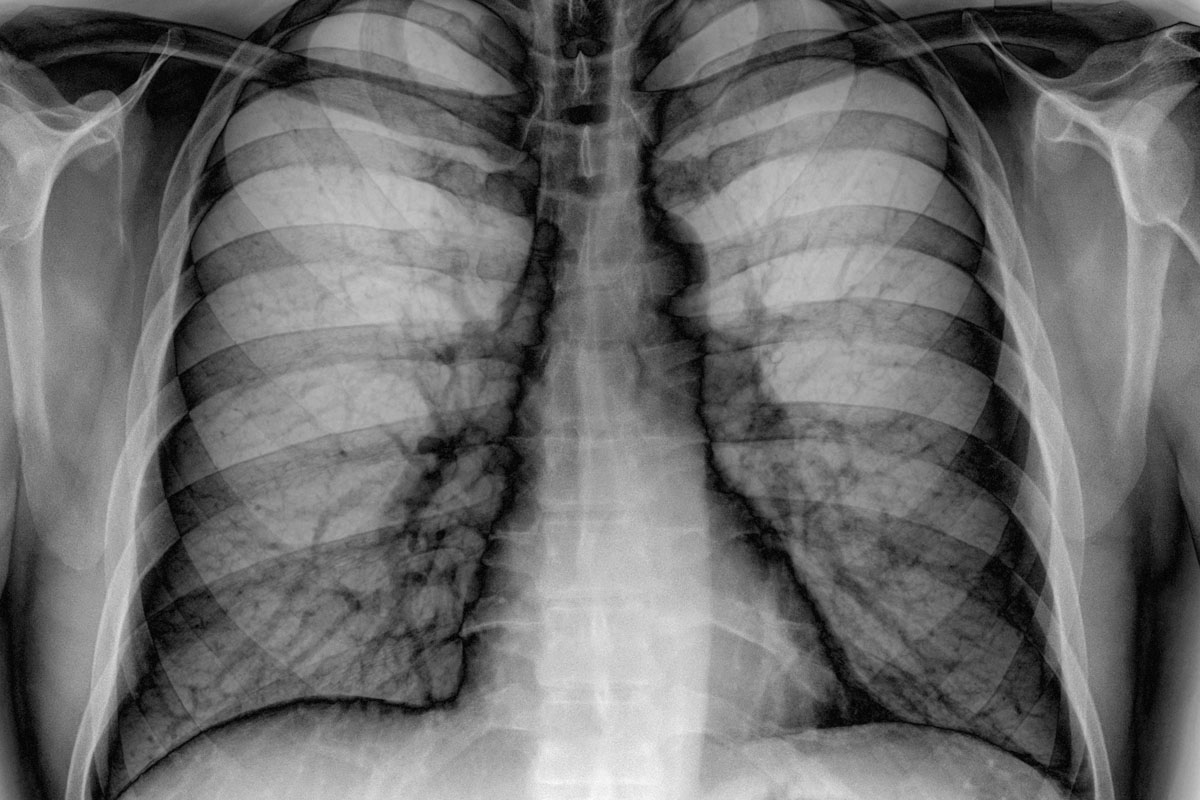 Campanie de prevenţie a cancerului pulmonar