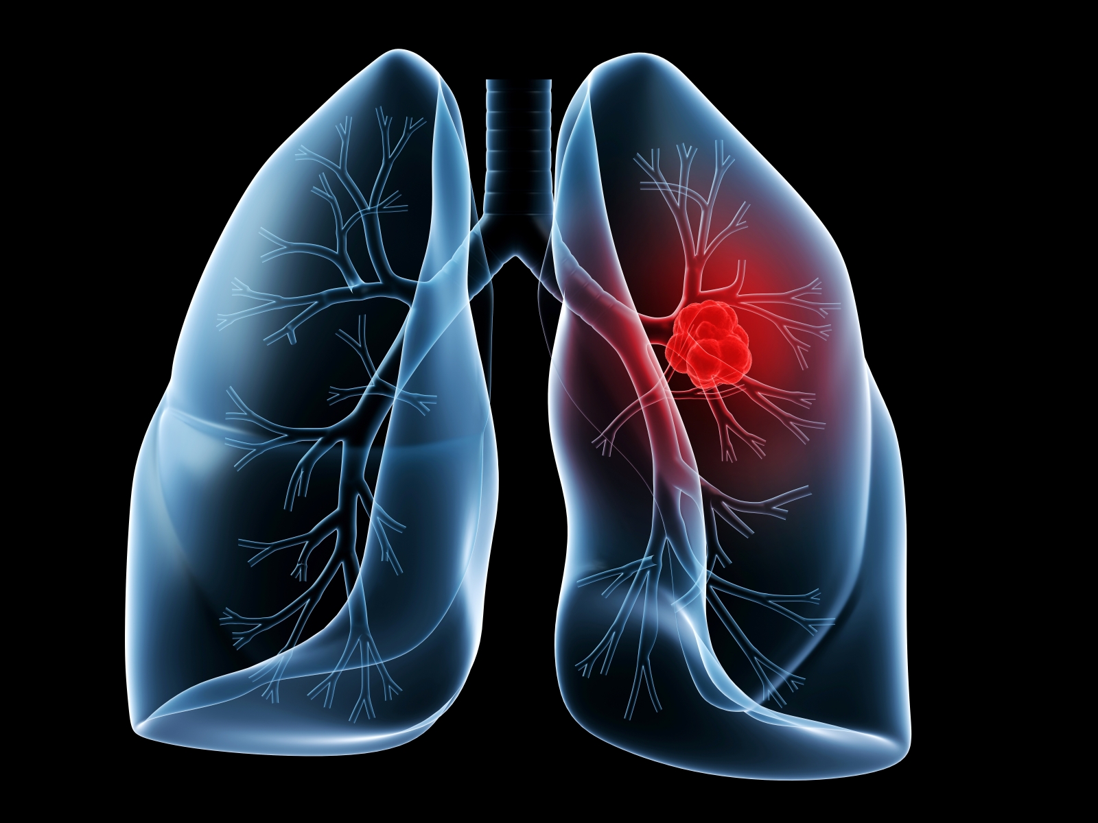 Cancerele pulmonare reprezintă aproximativ 13% dintre cazurile noi de cancer