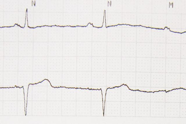 Electrocardiograme, în cabinetele medicilor de familie suceveni