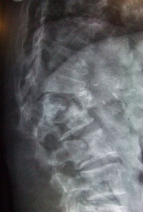 Testări gratuite de osteodensitometrie