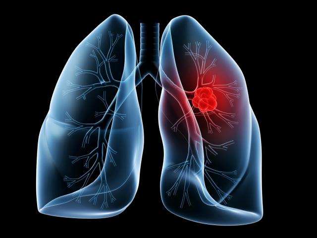Cancerele pulmonare reprezintă aproximativ 13% dintre cazurile noi de cancer