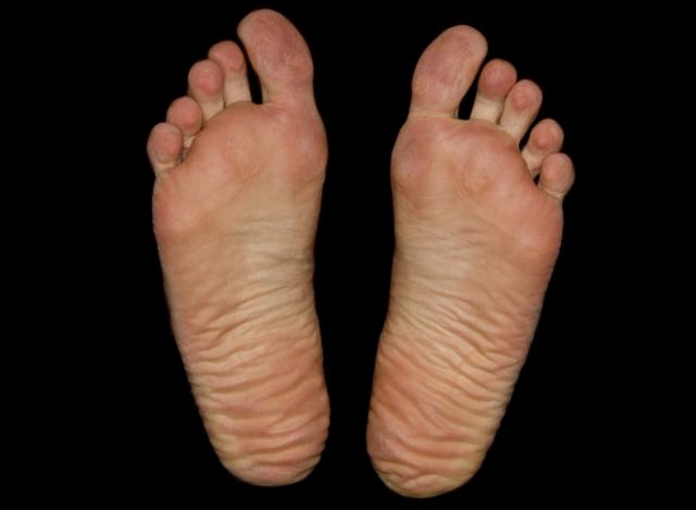 Simptome şi tratament în infecţia fungică a piciorului