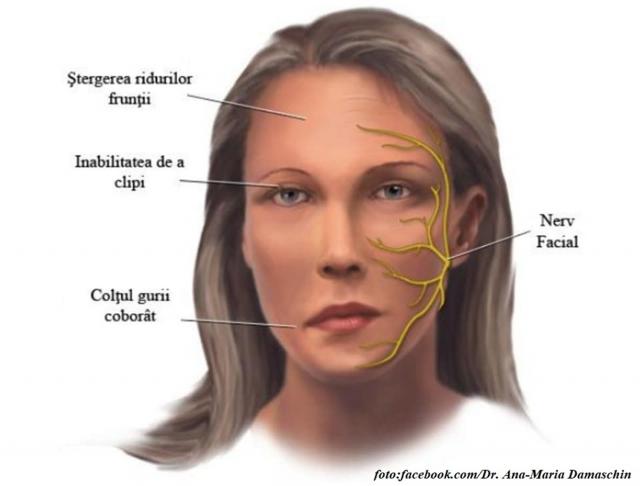 Pareza facială periferică, o boală a nervului facial – interviu cu dr. Ana-Maria Damaschin, medic primar recuperare medicală