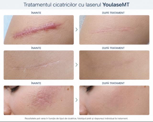 Laserul CO2 Quanta YouLaser MT pe înțelesul tuturor