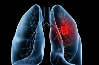 Campanie de informare asupra riscurilor cancerului pulmonar