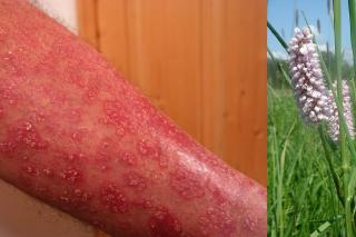 Trei remedii naturale pentru neurodermatită