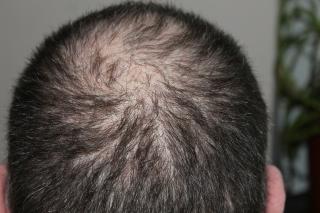 Suc natural pentru prevenirea căderii părului