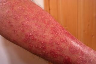 Despre tratamentele moderne contra psoriazisului