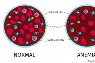 Anemia – interviu cu Dr. Ionela Adriana Vlăduțu