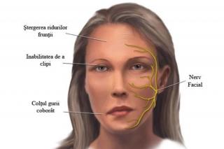 Pareza facială periferică, o boală a nervului facial – interviu cu dr. Ana-Maria Damaschin, medic primar recuperare medicală