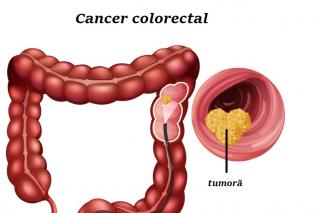 Screeningul pentru cancerul colorectal – interviu cu doamna doctor Nicoleta Dimitriu, manager de dezvoltare în cadrul Spitalului Providența