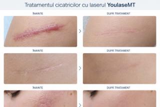 Tratamentul cicatricilor cu Laserul CO₂ Quanta YouLaser MT