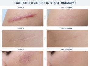 Laserul CO2 Quanta YouLaser MT pe înțelesul tuturor